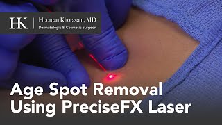 Age Spot Removal Using PreciseFX Laser by Dr Hooman Khorasani [upl. by Jarlath]