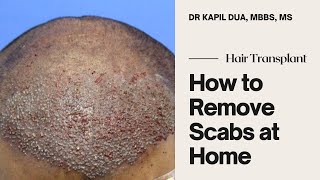 How to Remove Scabs after Hair Transplant at Home  Dr Kapil Dua [upl. by Zeena841]