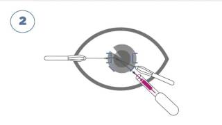 Supporting device for the insertion of an intraocular lens [upl. by Harness402]