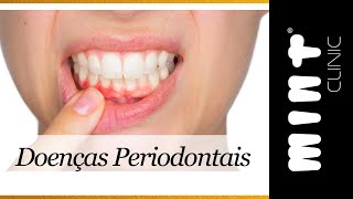 Doenças Periodontais  Gengivite e Periodontite  Clínica Mint [upl. by Cronin]