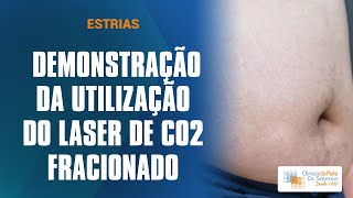 Estrias Laser Co2 Fracionado [upl. by Frodi]