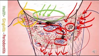 Periodontitis Cure by Bonner Method microscope caricature and drawing Gum disease [upl. by Weatherby]