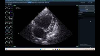 IQ 306 AFI RV ECHOPAC ANALYSIS HEPATOMA PTE ECHOCARDIOGRAPHY [upl. by Iddo]