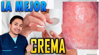 La MEJOR Crema para la Balanitis en Hombres [upl. by Ait810]