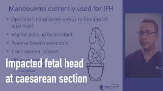 Impacted fetal head at caesarean section [upl. by Dust274]