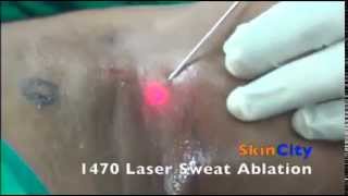 Indias First 1470 Laser Sweat Ablation LSA for Axillary Hyperhidrosis excess under arm sweating [upl. by Kulsrud53]