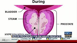 Rezum procedure for enlarged prostate less invasive with great results  Medical Minute [upl. by Renae]