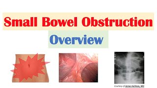 Small Bowel Obstruction SBO  Risk Factors Causes Signs amp Symptoms Diagnosis Treatment [upl. by Yme]