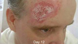 Time lapse video and pictures of Basal Cell Carcinoma removal skin cancer treatment no surgery [upl. by Odarbil264]