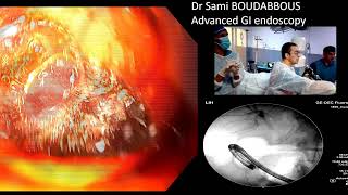 ERCP for severe acute cholangitis [upl. by Warring]