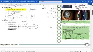 Ophthalmology 5 – Cataract amp chemical injury [upl. by Abott]