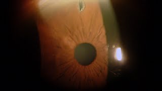 Iridotomia Laser per Glaucoma  Studi Oculistici Abbondanza [upl. by Smiga159]