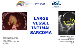 LARGE VESSEL INTIMAL SARCOMA [upl. by Nodlew541]