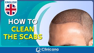 How to clean the scabs after 11 days from the hair transplant operation [upl. by Codee359]