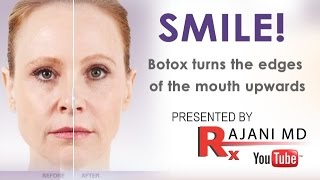 SMILEBotox Injected to Turn the Mouth UpwardsRajaniPortland [upl. by Julianne]