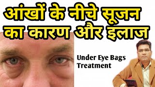 How to Treat Puffy Eyes Under eye Bags amp What are The Main Causes [upl. by Katlin808]