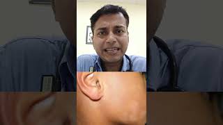 Pityriasis Alba For Consultation please call on 7400124238 shortvideo motivation [upl. by Conant102]