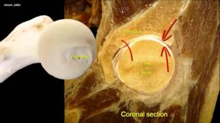 Femoral neck fracture  applied anatomy [upl. by Llewsor]