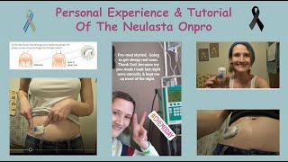 Personal Experience amp Tutorial of the Neulasta® Onpro® [upl. by Aneehsar]