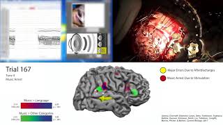 Mapping music ability during awake brain surgery [upl. by Low722]