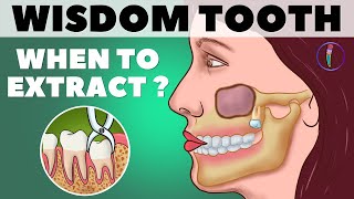 Wisdom Teeth Removal  When to extract Wisdom teeth Third molar  Animation  Medinaz [upl. by Durno]