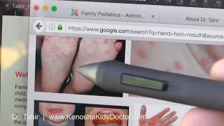 What Is Hand Foot Mouth Disease And How To Help Your Child [upl. by Pearle]