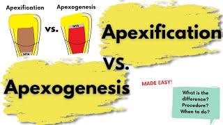 Apexification vs Apexogenesis I Complete comparison I Endodontics [upl. by Ylnevaeh116]