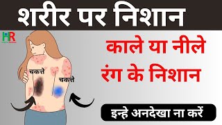 Thrombocytopenia in hindi  थ्रोम्बोसाइटोपेनिया के कारण क्या हैं [upl. by Brooking]