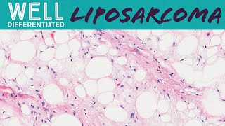 Well differentiated liposarcoma aka atypical lipomatous tumor pathology sarcoma soft tissue tumor [upl. by Rahman]