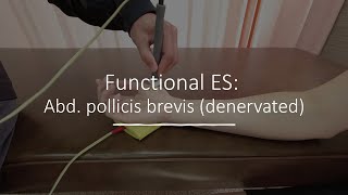 Functional ES Abduction pollicis brevis denervated [upl. by Anuahc189]