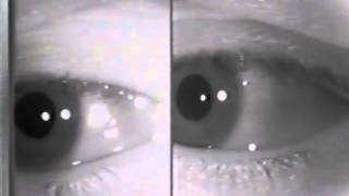 Physiologic EndGaze Nystagmus [upl. by Paulsen430]