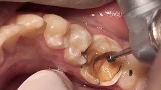 Deep tooth caries going to root canal treatment dentist denta teethrestoration howtocleanteeth [upl. by Ille]