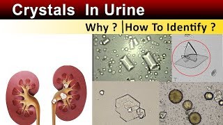 Crystals In Urine  Why amp How to Identify [upl. by Aillimat]