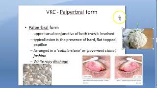 Ophthalmology 088 b Vernal KeratoPathy VKC Shield ulceration Cornea Eye PseudoGeronToxon Types [upl. by Nisse590]