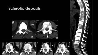 Radiology  Spine Tumours  Neoplastic lesions [upl. by Nnyluqcaj275]