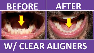 Invisalign Braces Before and After Overbite Crowding Teeth Cost Pain Tips 3M Clear Aligners [upl. by Hahn]