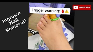 Ingrown toenail removal [upl. by Ostraw441]