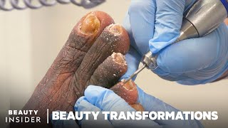 How Medical Pedicures Transform Feet [upl. by Enyak]