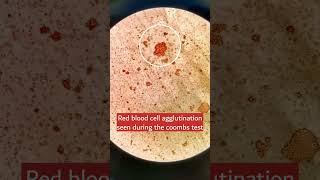 Red cell agglutination hematology microscopy [upl. by Ymerej514]