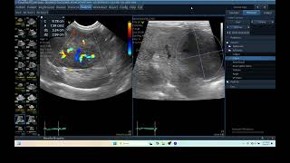 IQ 279 LIVER ULTRASOUND HEPATOMA ECHOPAC ANALYSIS ECHOCARDIOGRAPHY COLOR FLOW MAMMING [upl. by Llywellyn111]