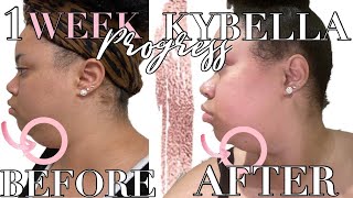 1 Week PostInjection Update  Kybella Vlog Part 2 [upl. by Ikkiv]