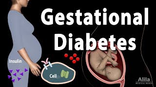 Gestational Diabetes Animation [upl. by Davidde33]