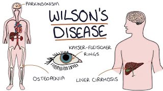 WILSON DISEASE GENETIC DISORDER OF LIVERBSC NURSINGdailypost [upl. by Wiltshire]