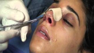 The Kotler Nasal Airway  Removal of the Airway [upl. by Gabbey455]