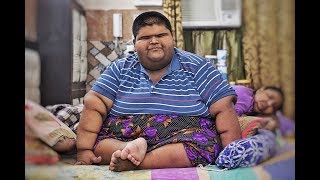 Worlds Heaviest Teenager Weighing 237Kgs  Loses Weight [upl. by Aicinat]