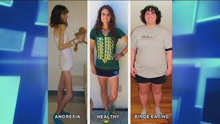 How an Anorexic Can Become a Binge Eater [upl. by Corwin]