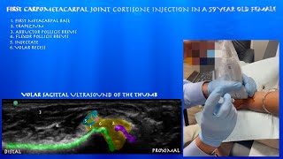 Ultrasound Guided Carpometacarpal Joint Injection in a 59 Year Old Female by probeultrasound [upl. by Niledam]