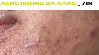 Acne Treatment Huong Da Nang 718  Remove Blackheads [upl. by Hynda]