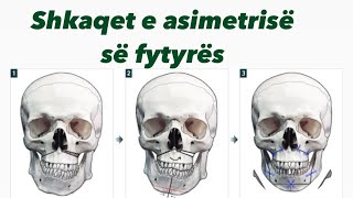 Asimetria e fytyrës nga se shkaktohet alpha [upl. by Beall619]