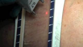 ENG  Varicose Veins treatment with Multidiode Endo Laser [upl. by Gervais]